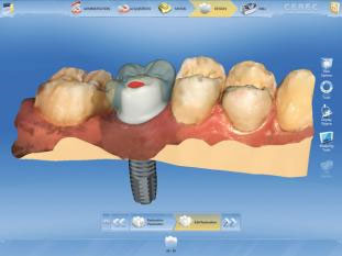 CEREC AC OMNICAM ПРОСТОЕ СКАНИРОВАНИЕ БЕЗ АНТИБЛИКОВОГО СПРЕЯ 13.jpg