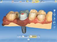 CEREC AC OMNICAM ПРОСТОЕ СКАНИРОВАНИЕ БЕЗ АНТИБЛИКОВОГО СПРЕЯ 19.jpg