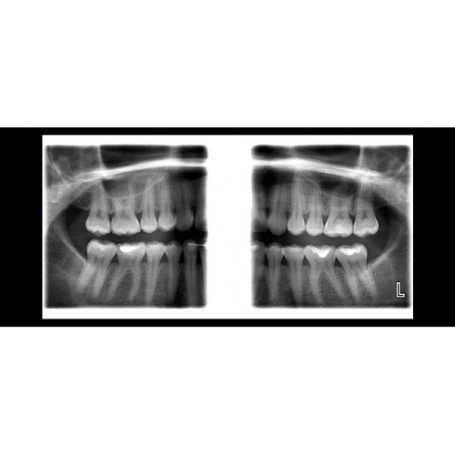 Planmeca ProOne - универсальный цифровой ортопантомограф