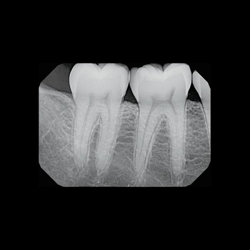 KaVo Gendex GXS-700 - система компьютерной радиовизиографии (сенсор №1)