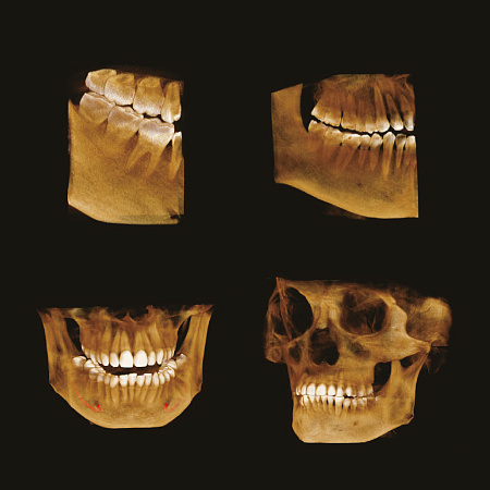 GENORAY Papaya 3D 23x14 - компьютерный томограф с цефалостатом One Shot 