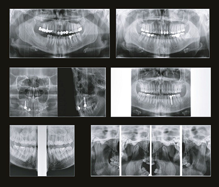 GENORAY Papaya 3D Plus 16x14 - компьютерный томограф с цефалостатом