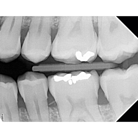 Acteon X-Mind DC Mobile - высокочастотный мобильный дентальный рентгеновский аппарат