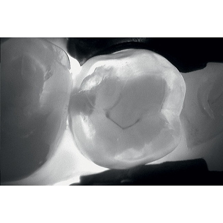 KaVo DIAGNOcam - прибор для диагностики кариозных поражений