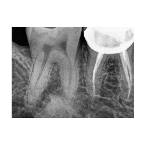 Carestream Kodak RVG 5200 - радиовизиограф