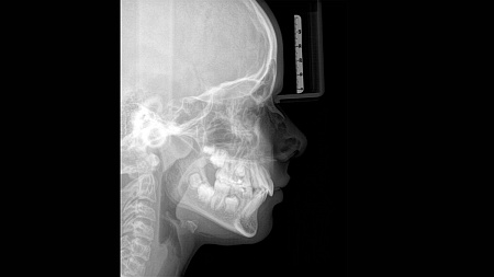 Sirona Orthophos SL 3D (11x10) – Дентальный томограф